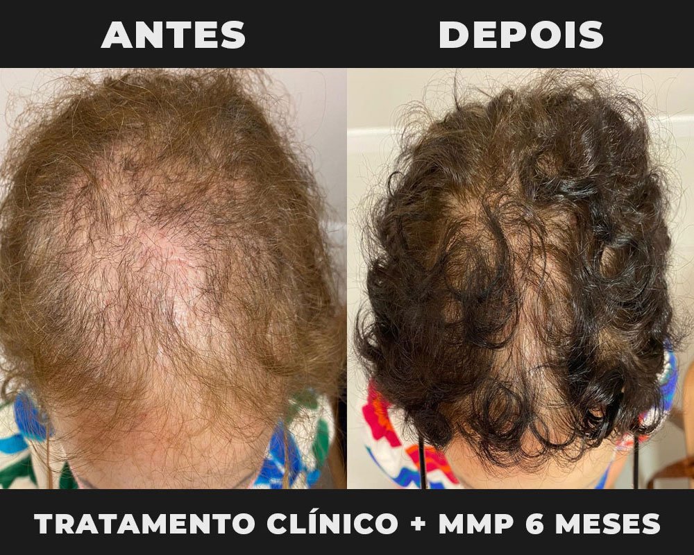 Entendendo o Lipedema - Clínica Eclat  Dermatologia, Tricologia, Implante  Capilar, Cardiologia e Nutrologia em Campinas